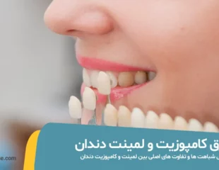 فرق کامپوزیت و لمینت دندان