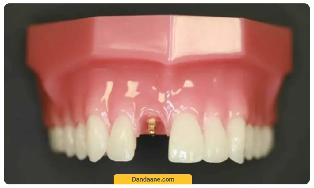 تصویر مینی ایمپلنت در دهان 