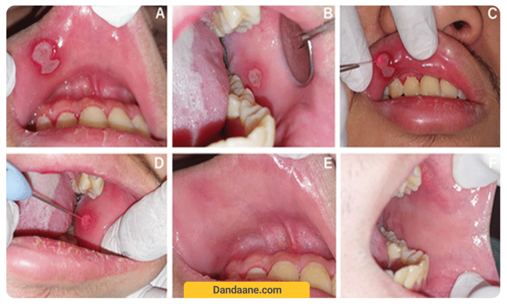 عکس آفت دهان 