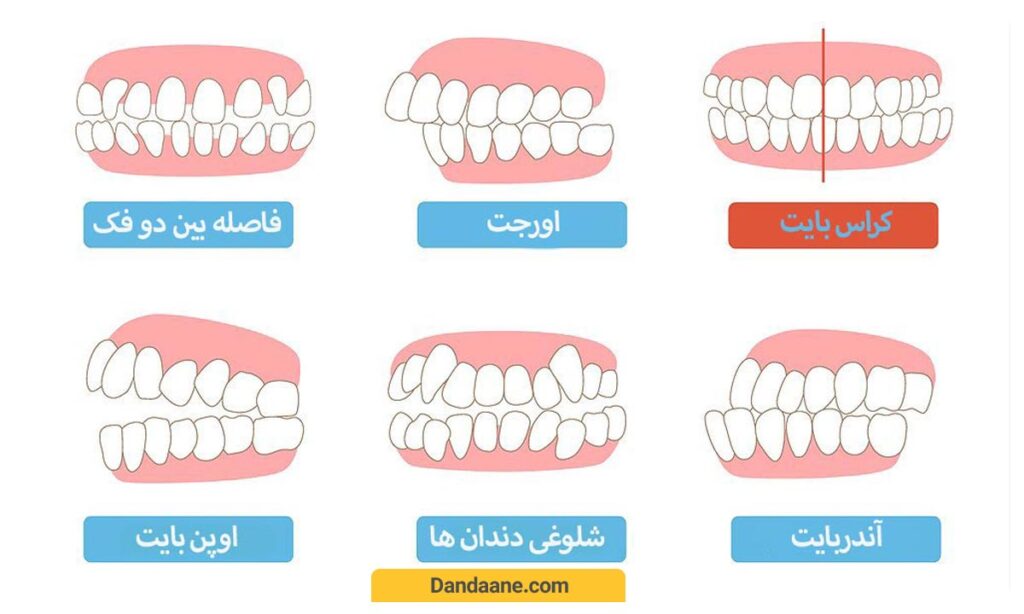 تصویری از  انواع بهم ریختگی دندان ها 