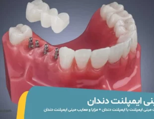 مینی ایمپلنت دندان