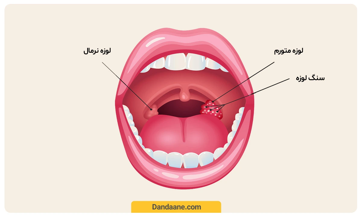 تصویر یک لوزه متورم و دارای سنگ در کنار یک لوزه عادی و سالم