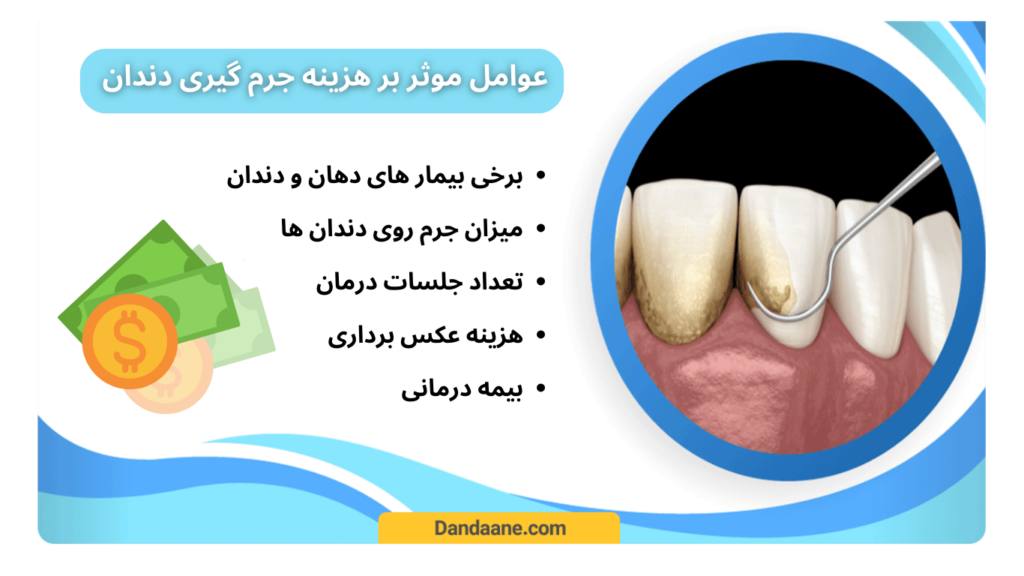 موارد موثر در هزینه جرم گیری دندان