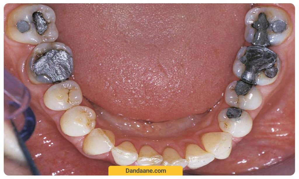دندان های پر شده با آمالگام سیاه 