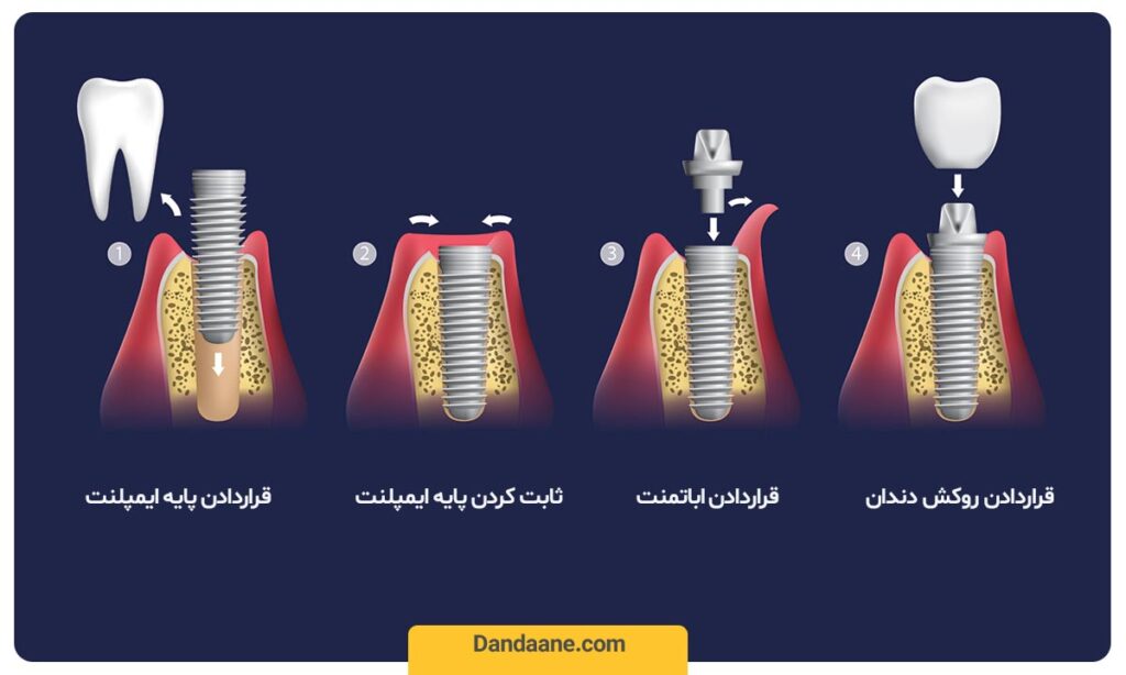 مراحل ایمپلنت فوری دندان