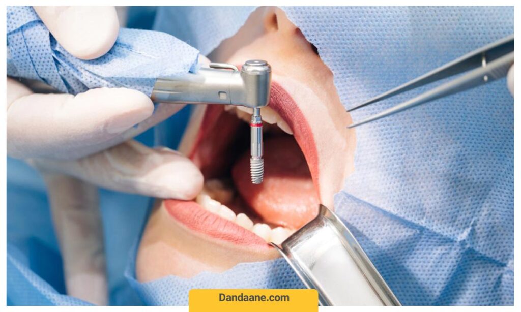 دندانپزشک در حال قرار دادن پایه ایمپلنت