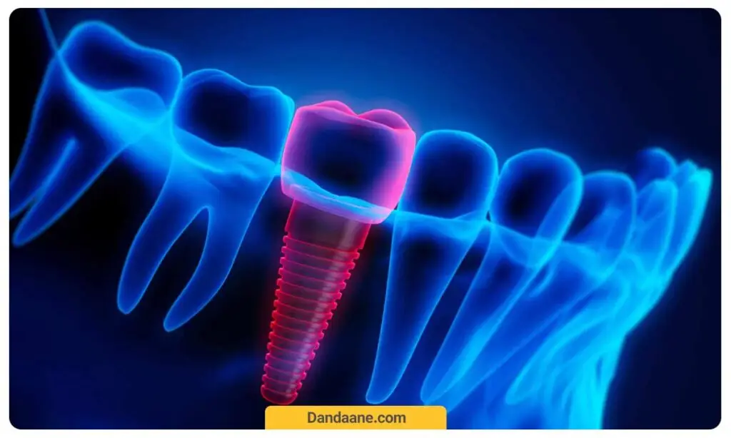 عوارض بعد از ایمپلنت دندان