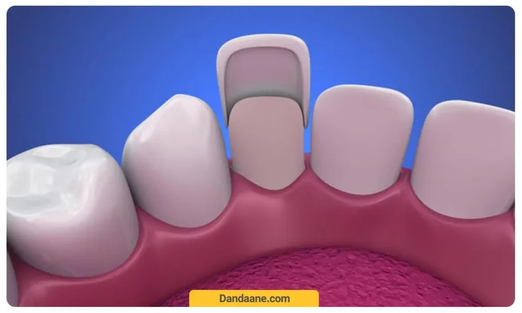تصویر شماتیک از قرارگیری لمینت بر روی دندان 